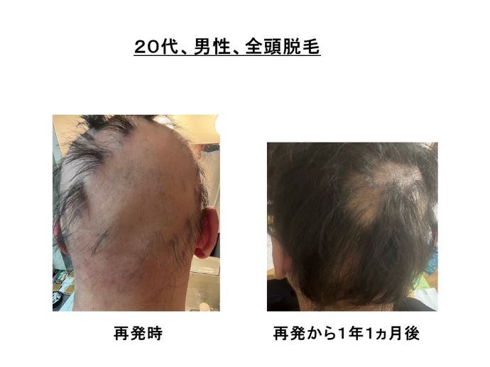 円形脱毛症　病院